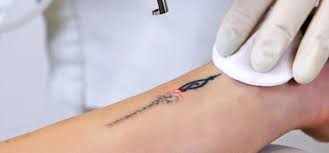 tattoo removal dr walia s skin and