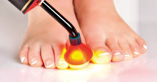 light therapy for foot fungus