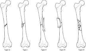 Educational video describing winquist and hansen classification of the femur. Femoral Shaft Fractures Radiology Key