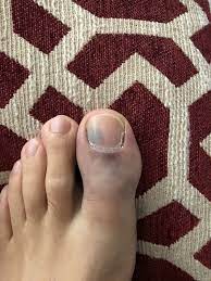 bruised toenail from trauma