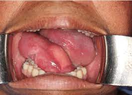 floor of the mouth swelling