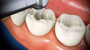 Diagnosis and treatment of root canal therapy