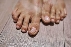 black toenail symptoms causes treatment