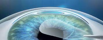 frequently asked questions lasik
