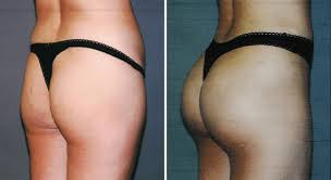 How much is a bbl in dallas? Brazilian Butt Lift Houston Dr Nikko Cosmetic Surgery Center