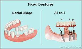 low cost fixed dentures abroad mexico