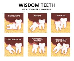 wisdom teeth removal cost in delhi