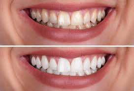 teeth whitening haddonfield marlton
