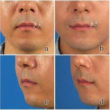 corner mouth lift lateral