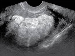 focal uterine lesions radiology key