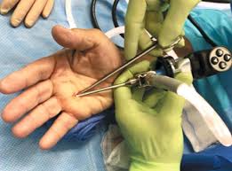 endoscopic trigger finger release