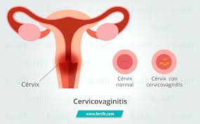 cervicoinitis qué es síntomas y