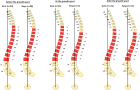 Natural Sagittal Spino Pelvic Alignment In Boys And Girls
