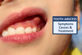 tooth abscess dental abscess symptoms