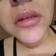 after juvederm ultra lip injections