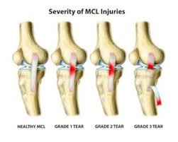 There are three grades for ankle sprains determined by the amount of force. Medial Collateral Ligament Mcl Injuries Core Em