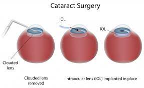 what types of cataract surgery are