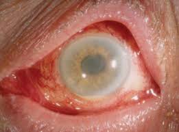 post cataract surgery inflammation a