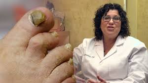 meet a toenail fungus expert vice