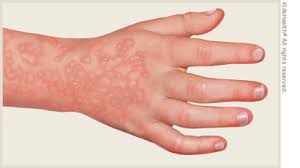 Itchy hands may also be accompanied by a rash, a burning feeling, raised red bumps on the skin, dry and flaky skin, and thickening of the skin. Fifth Disease For Parents Nemours Kidshealth