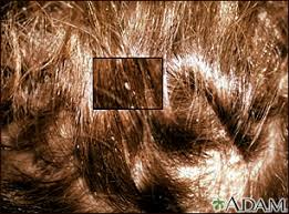 head lice information mount sinai