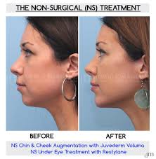 If you don't have flawless, regular contours, if you avoid being photographed in profile, a jawline. Non Surgical Before And After Results Www Sculptmd Com 514 728 5783 Facial Fillers Nose Fillers Botox Fillers
