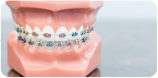 Braces with dental insurance cost. Cost Of Braces How Much Braces Really Cost Fusion Orthodontics