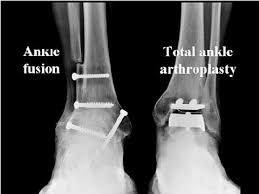 total ankle arthroplasty