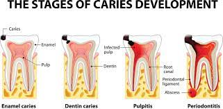 the cure for periodonis part 4