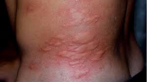 skin rash causes 71 pictures of