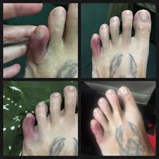 This article looks at the symptoms of a broken small toe, along with some other problems that can cause pain and swelling in the area. Pinky Simple Complexity