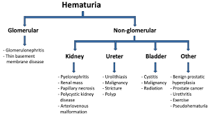Causes Of Hematuria Glomerular Vs Non