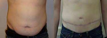 how much does a tummy tuck cost