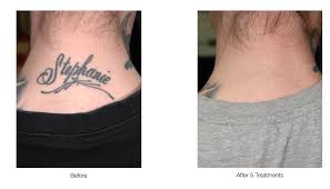 When treatment is more intensive, as it may be when performing acne scar reduction or tattoo removal, it may take 24 hours for swelling and redness to subside. The Lumenis Piqo4 Tattoo Durango Co Dermatologist