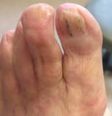 red spot under toenail causes home
