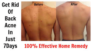 get rid of back acne in just 7 days