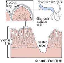 peptic ulcer guide causes symptoms