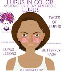 faces of lupus