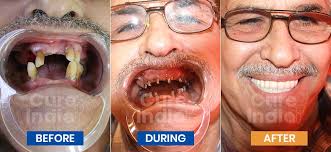 full mouth dental implants cost 10