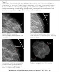 The Development Of Digital Breast Tomosynthesis At Mgh From