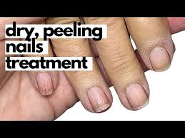 condition dry brittle nails