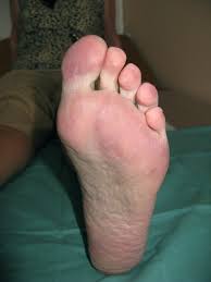 the purple toe syndrome in female with