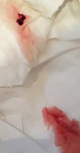 ping small clots tissue