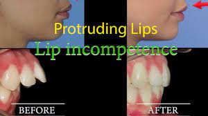 lip protrusion braces