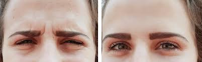 how to fix asymmetric eyes with botox