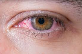 dry eyes allergies or an infection