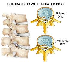 bulging disc goes untreated