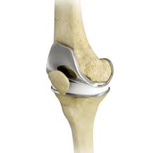 total knee replacement carmel ny knee