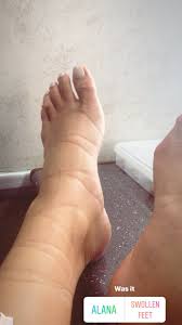 shay mitc posts photo of swollen feet