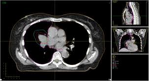 lung cancer radiotherapy